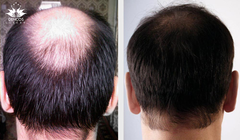 13 cách trị rụng tóc cho nam hiệu quả nhất hiện nay  websosanhvn