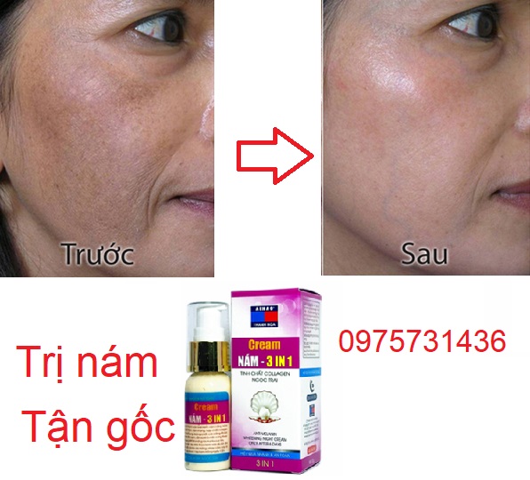 Kem Aihao trị nám 3 in 1 ngọc trai collagen
